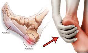 Photo of What are the symptoms of plantar fasciitis?